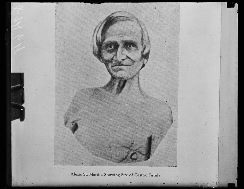 Dibujo de St Martin mostrando el lugar donde tenía la fístula estomacal.